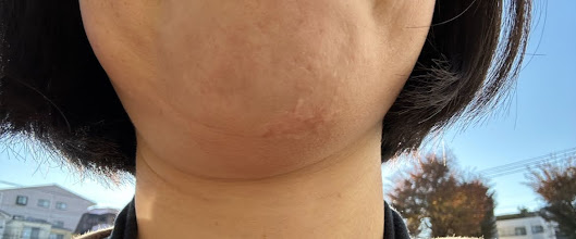 現在のアゴの写真（ケロイドあり）